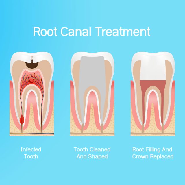 Endodontics Dentistry - Pachem Dental Clinic